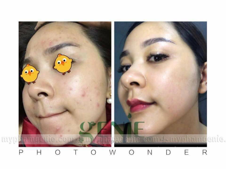 Kem trị mụn SOS