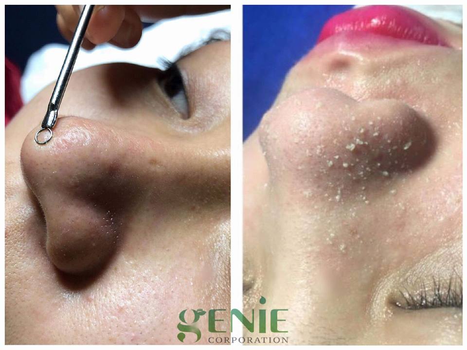 Ủ mụn Genie