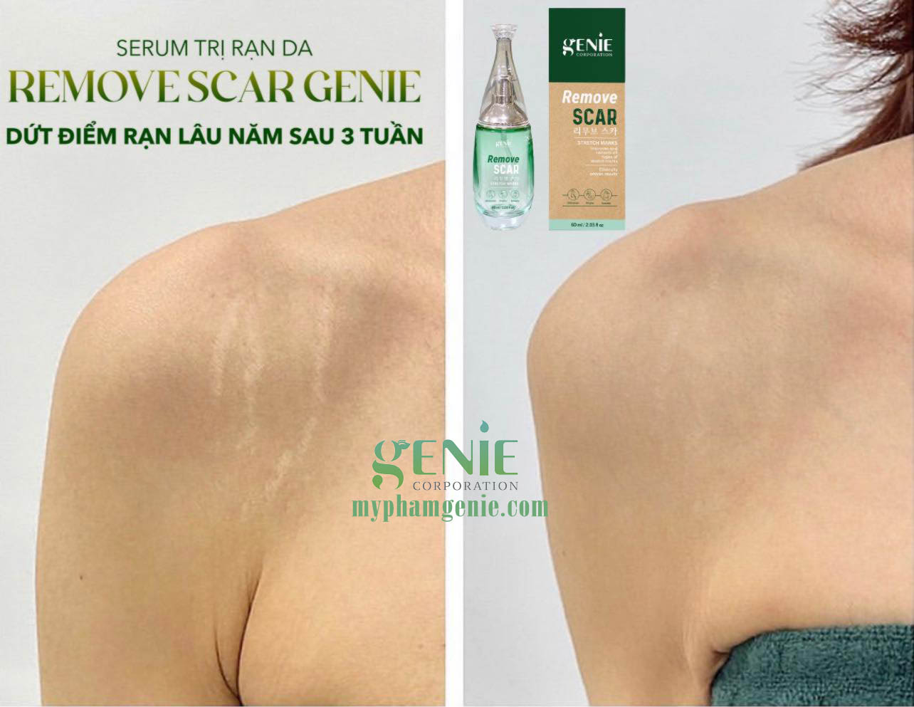 Tại sao rạn da xuất hiện và điều trị chúng như thế nào