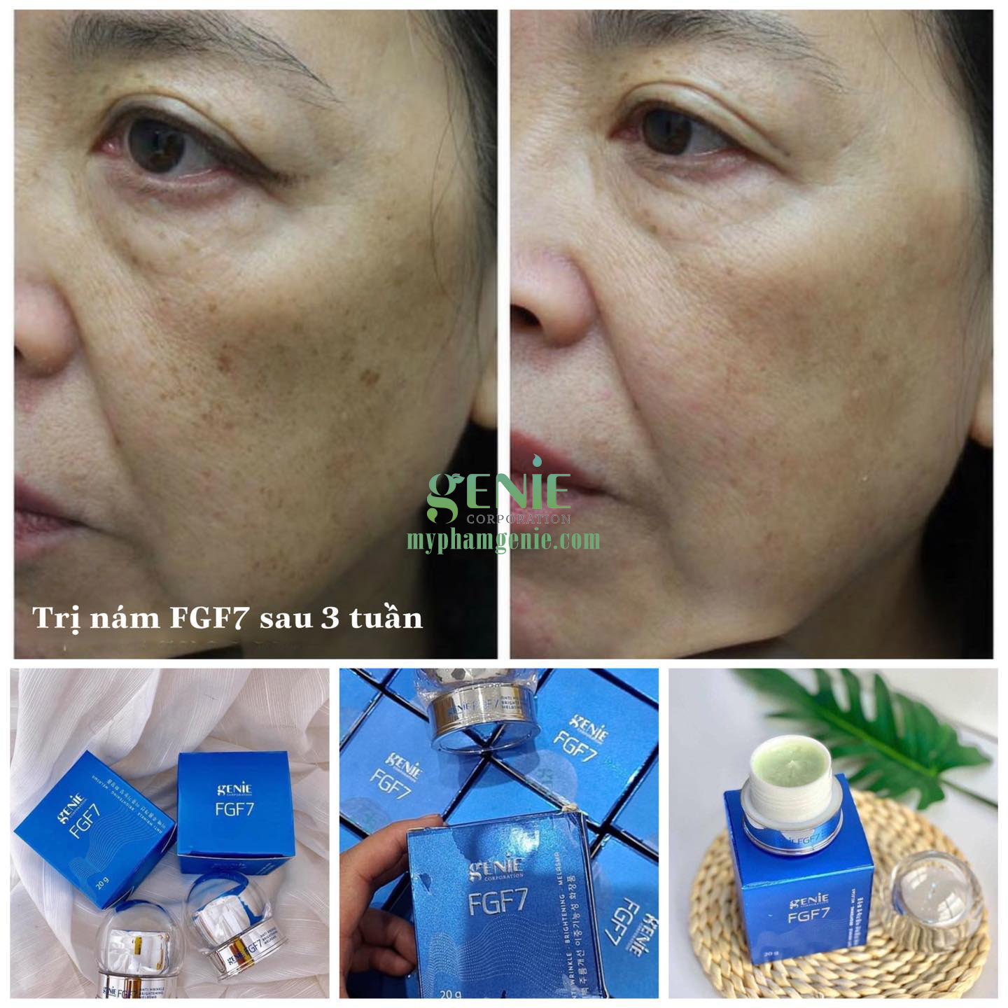 Kem trị nám loại nào tốt theo bác sĩ da liễu