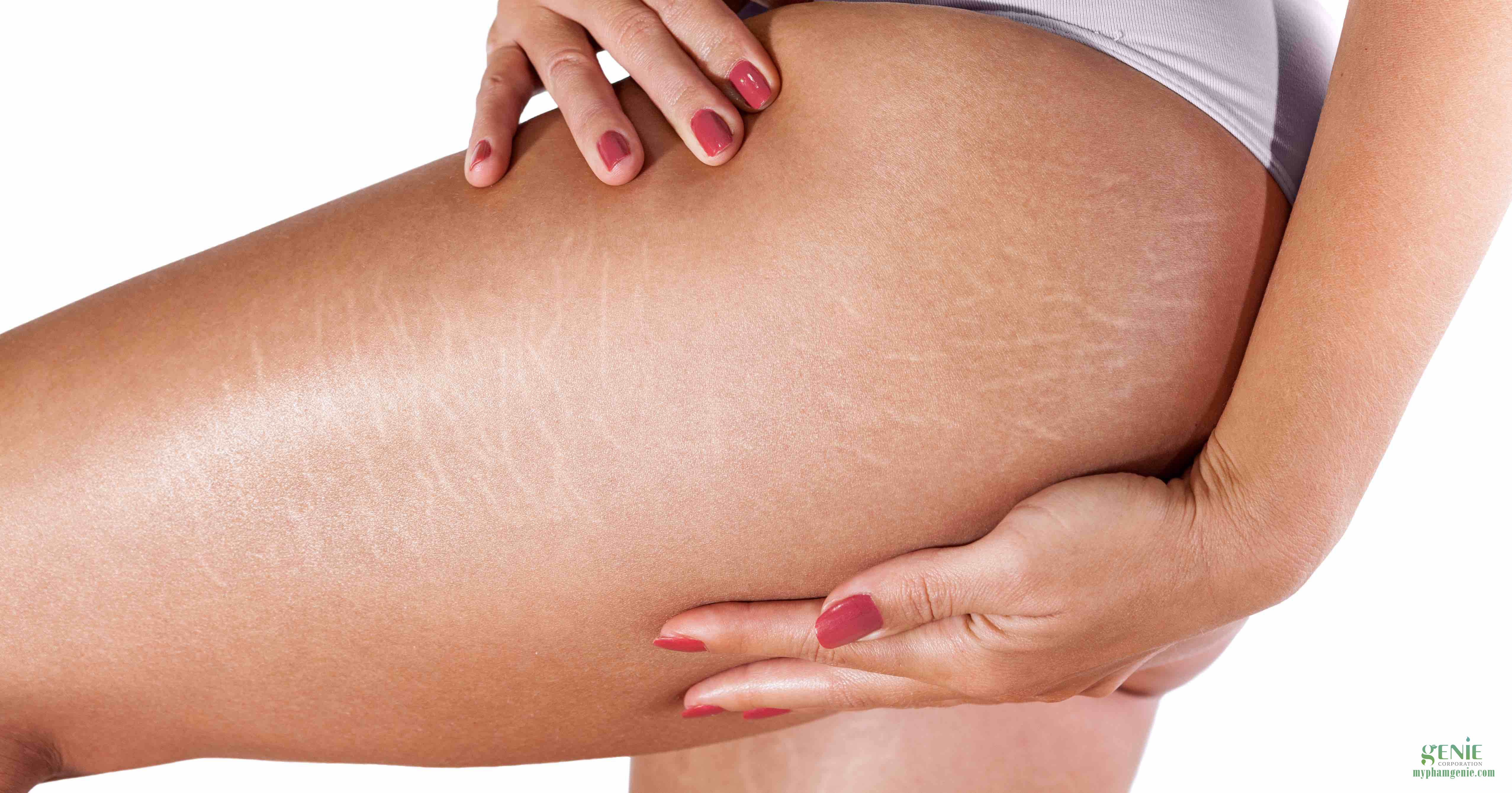 Rạn da mông điều trị như thế nào